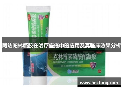 阿达帕林凝胶在治疗痤疮中的应用及其临床效果分析